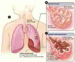 A Guide of Urgent Care Test for Pneumonia