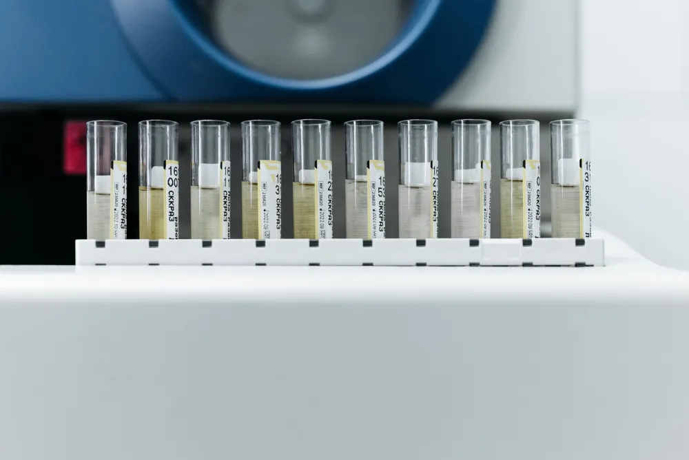 Medical technician analyzing urine sample for urinary tract infection diagnosis in lab
